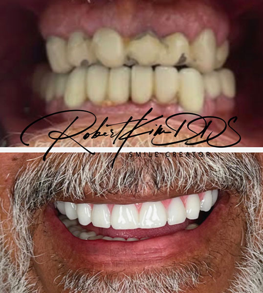 all on 4 dental implants chino hills