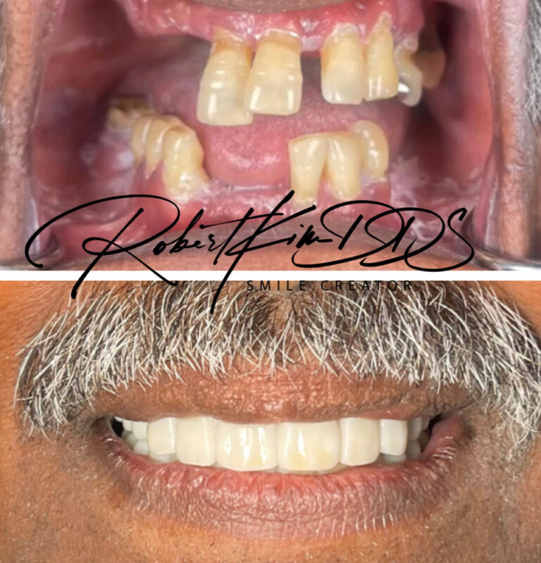 Before & After Photos Avion Dental Chino Hills, CA