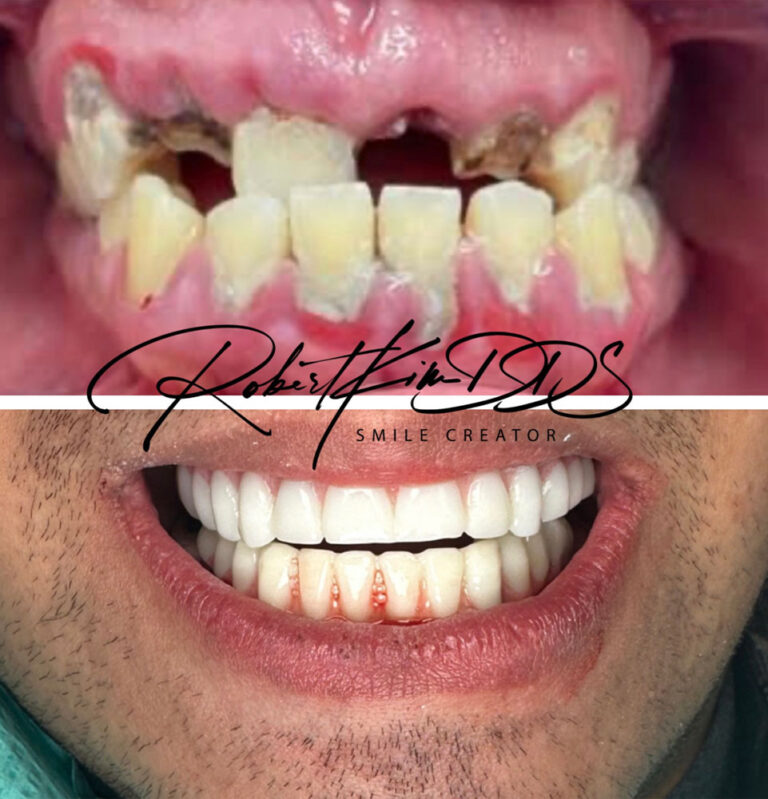 Before & After Photos Avion Dental Chino Hills, CA