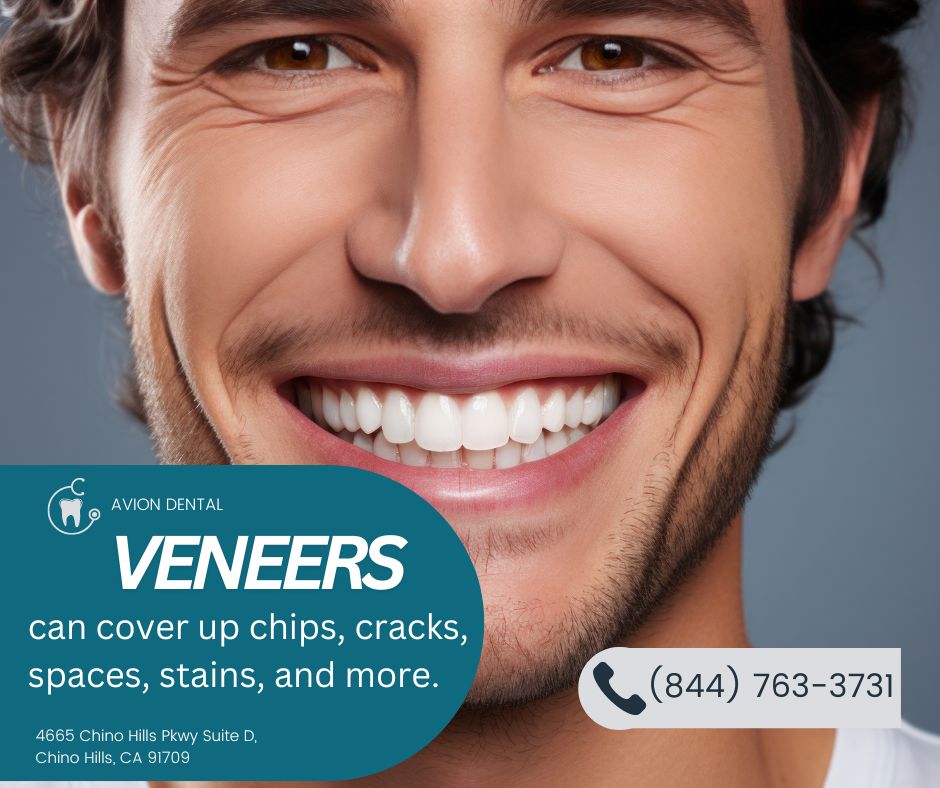 veneers in san bernardino